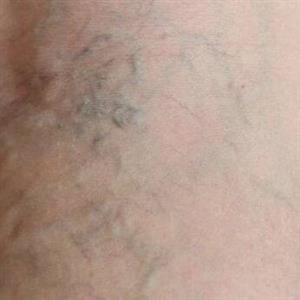 با چند عادت ساده از ابتلا به واریس پیشگیری کنیم