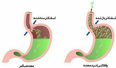 🟠 مشکل ریفلاکس در چه افرادی شایع تر است؟

در ایران از هر ۵ 