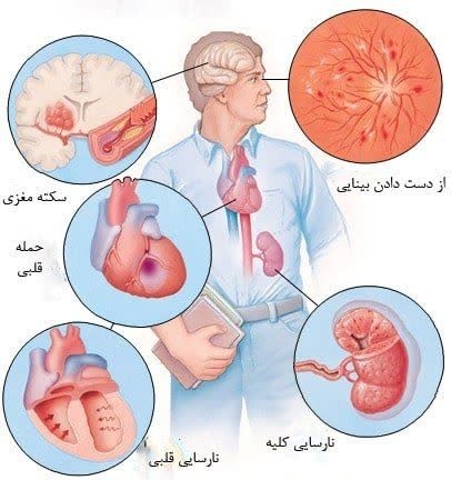 علائم فشارخون بالا