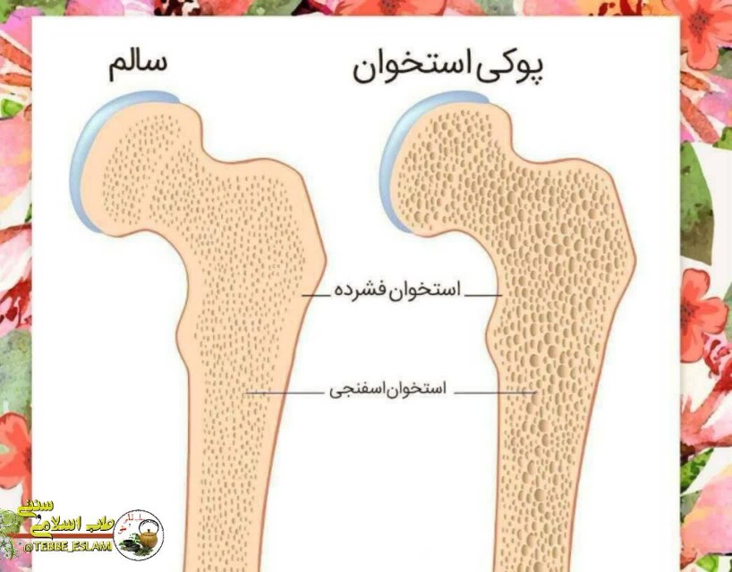 چه بیماری هیچ علامتی ندارد و راه درمانش چیست؟🔎

👈پوکی استخ