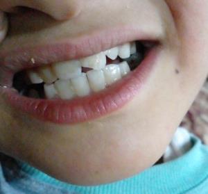 سلام امروز پسرم لبه دندون جلویش شکست بنظرتون چکارش کنم
