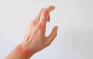 #خشکی_مفاصل
🔰 خشکی مفاصل در سالمندی
🔸یکی از آسیب‌های عضلان