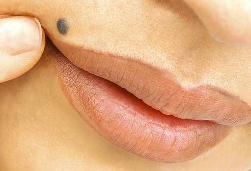 سلامت/ خال های پوستی، بی ضرر یا خطرناک؟