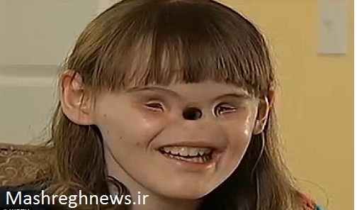 چهارگوشه دنیا/ دختری بدون بینی و چشم +عکس 