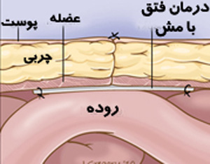 دکترسلام/ درمان فتق شکم و اقدامات پس از عمل فتق