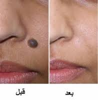 پوست و مو/ بهترین راه حذف خال گوشتی