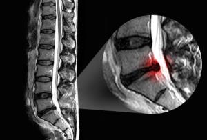 دکتر سلام/ روش های تشخیص ابتلا به فتق دیسک کمر