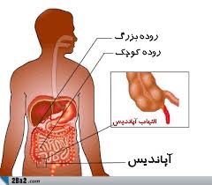 دکتر سلام/ تفاوت درد آپاندیس با سایر دردها