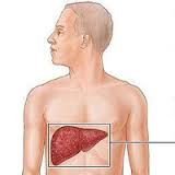 دکتر سلام/ خطری در کمین بیماران مبتلا به «سیروز کبدی»