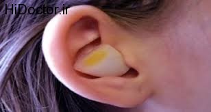 مشاوره سلامت/ اثرات معجزه آسای قرار دادن پیاز در گوش