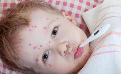 دکتر سلام/ تب مخملک چیست؟