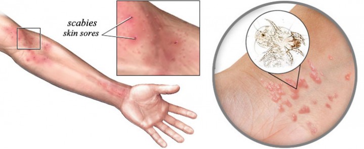 دکتر سلام/ گال چیست درمان گال چگونه است