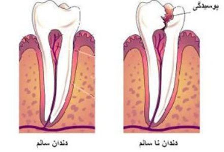 استفاده از داروی آلزایمر برای ترمیم طبیعی دندان های آسیب دیده