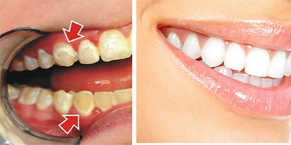 دهان و دندان/ ترفندهایی که دندان هایتان را مثل مروارید سفید می‌کند