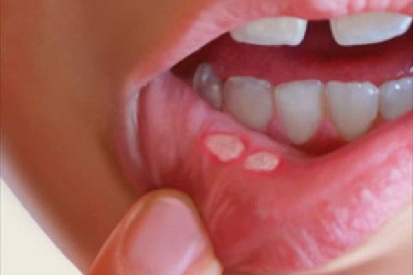 دهان و دندان/ بهترین درمان های آفت دهان