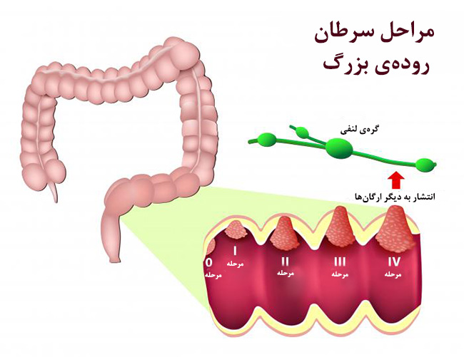 سرطان مقعدی چه علائمی دارد؟