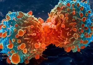 بهترین راه پیشگیری از ابتلا به سرطان سینه