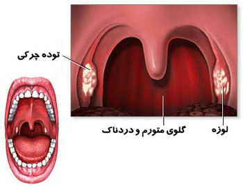 دکتر سلام/ گلو درد چرکی چیست؟