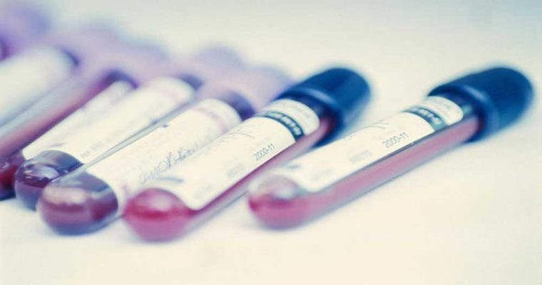 دکتر سلام/ علایم، علت و درمان فسفات خون بالا