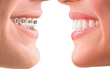 دهان و دندان/ زمان طلایی برای انجام ارتودنسی