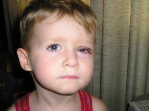 کودک/ درمان افتادگی پلک در کودکان