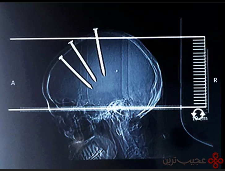 4گوشه دنیا/ مرد چینی با سه میخ در سرش!