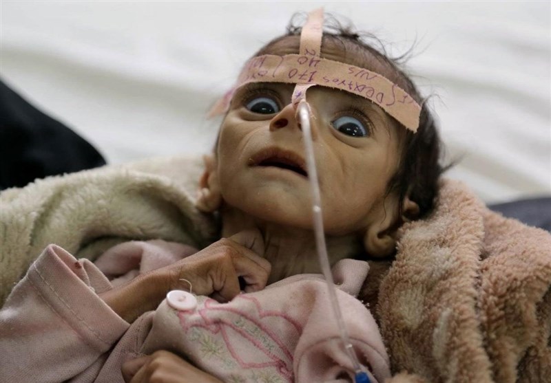 نگاهی به کابوس قحطی، بدبختی و گرسنگی در یمن