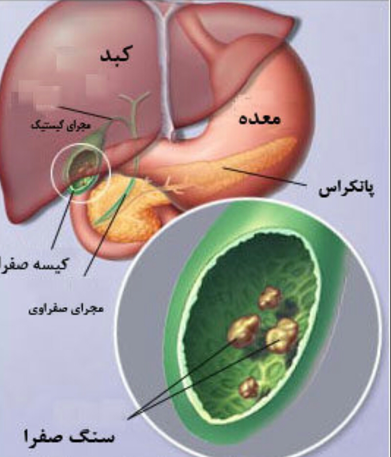 دکتر سلام/ سنگ کیسه صفرا چیست؟