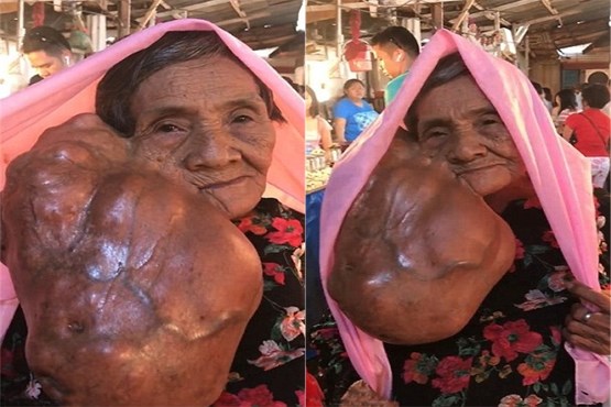 تومور عجیب در صورت بانوی فیلیپینی