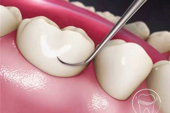 دهان و دندان/ هر آنچه باید درخصوص عصب‌کشی دندان‌ بدانید