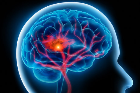 امید جدید در درمان سکته مغزی
