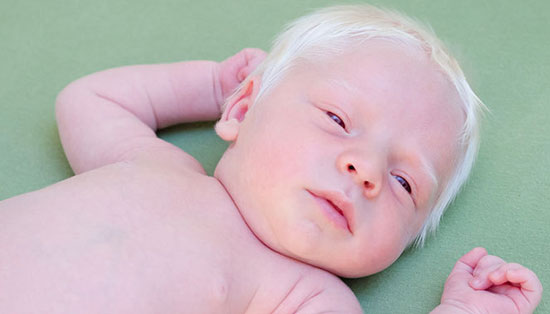 آخرین خبر | آلبینیسم؛ بیماری ژنتیکی افسانهای