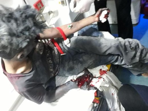 اولین حادثه چهارشنبه‌سوری، دست کودک 14 ساله را با خود برد