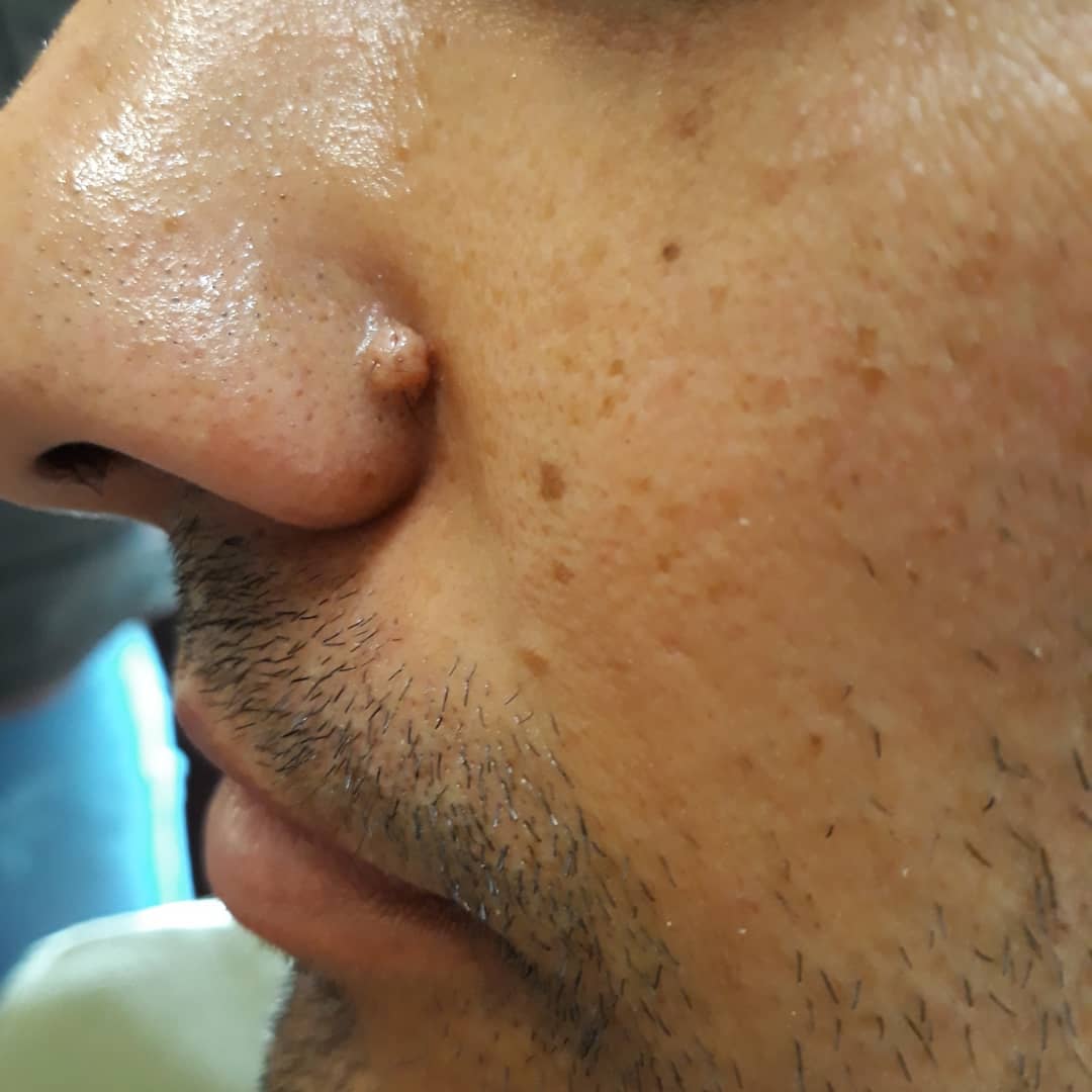 چطور خال گوشتی را از سرطان پوست تشخیص دهیم؟