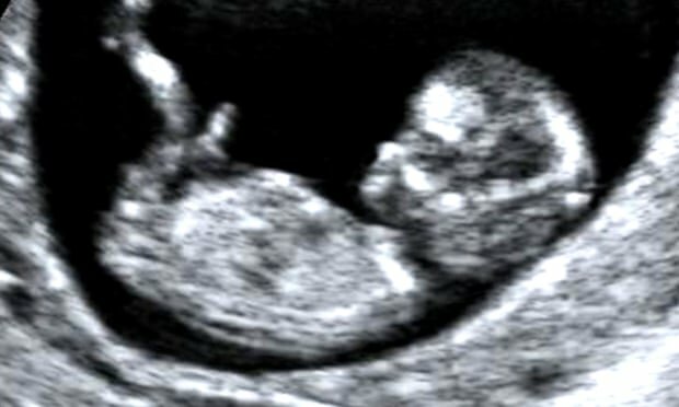 سونوگرافی از جنین برای یادگاری، ممنوع!