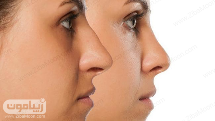 دانستنی های مهم قبل از جراحی بینی