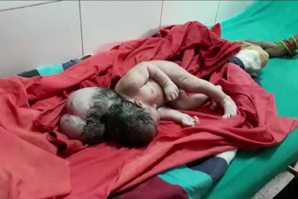تولد عجیب نوزاد با 3 کله بهم چسبیده!