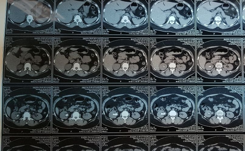 انجام عمل جراحی نادر سنگ کلیه در چابهار