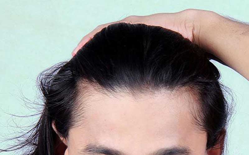 تفاوت کلاه گیس با پروتز موی سر چیست؟