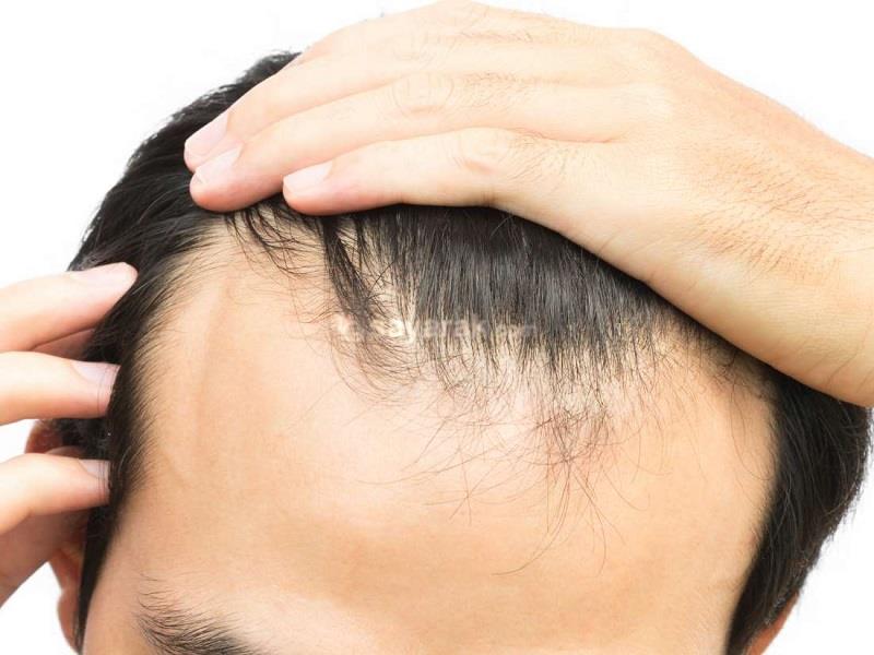 ریزش مو نشانه کدام بیماری است؟