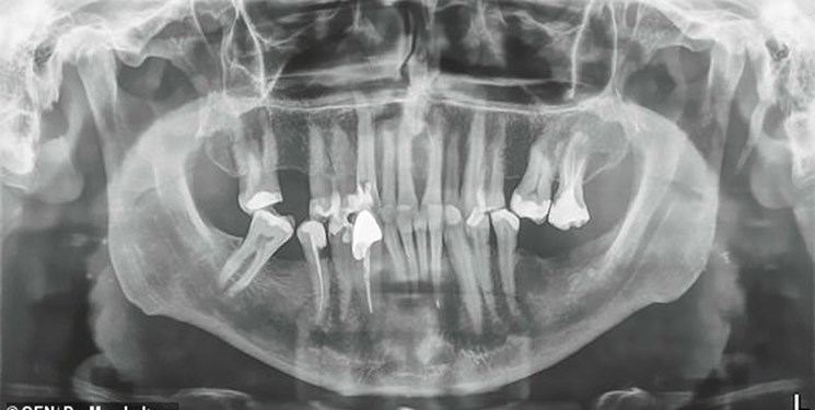 تولید مواد دندانپزشکی با «سایش» کمتر