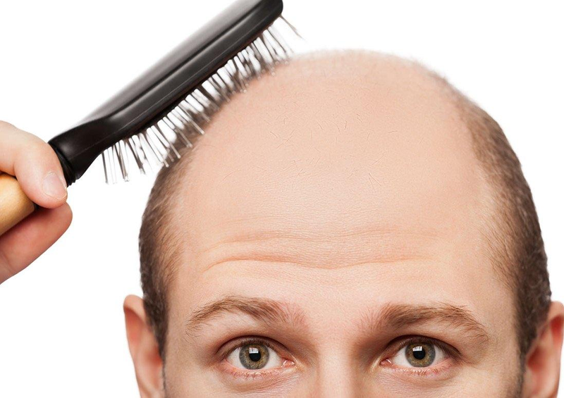 راه حل‌های تضمینی برای ریزش مو