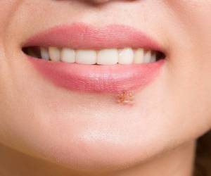اگر به تبخال دچار شدیم، چه کنیم؟