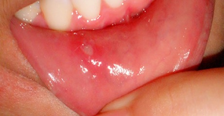 آیا زخم دهان نشانه سرطان است؟