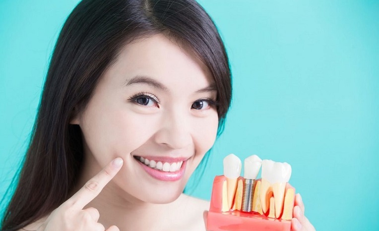  ۳ روش عالی جایگزین دندان از دست رفته