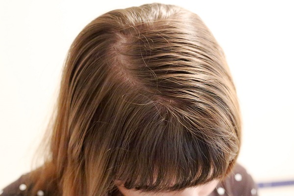 تاثیر قاعدگی بر پوست و مو چیست و چه باید کرد؟