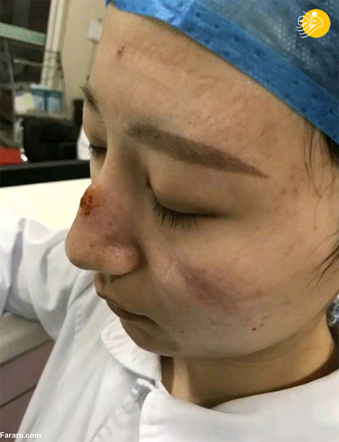 عکس/ اثر کبودی‌ ماسک و زخم روی صورت پرستاران و پزشکان