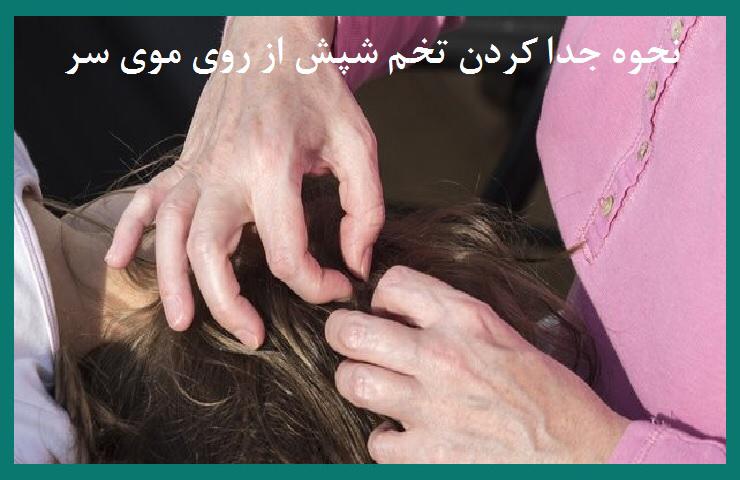 نحوه جدا کردن تخم شپش از روی موی سر