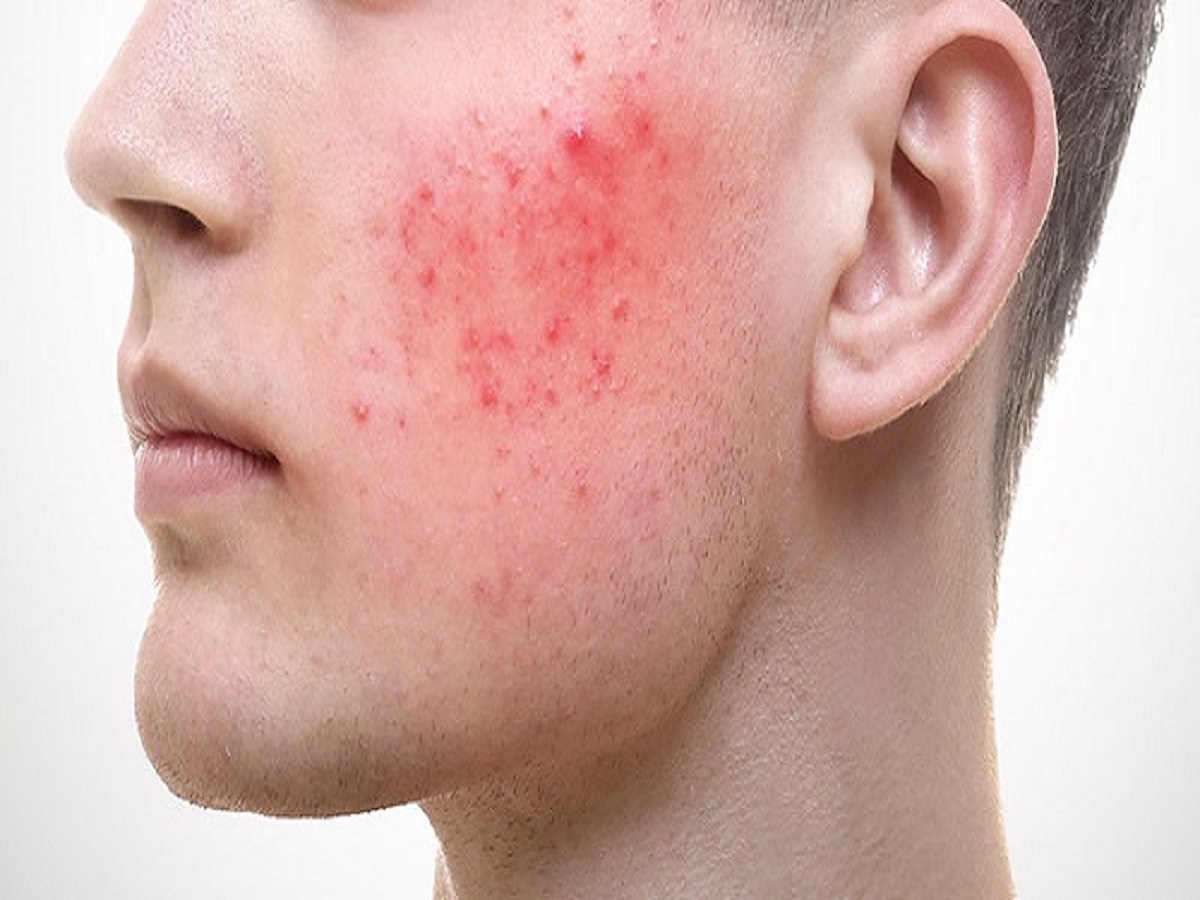 بیماری پوستی که در مردان شدید‌تر است