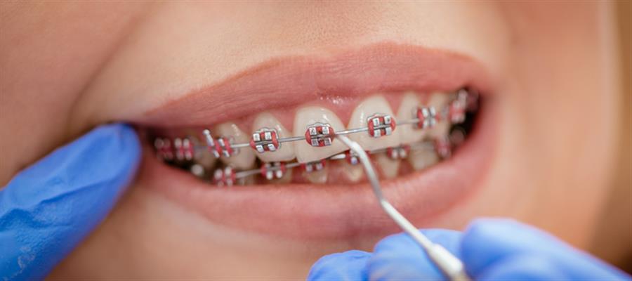 چگونه از دندان‌ها حین درمان ارتودنسی‌ مراقبت کنیم؟